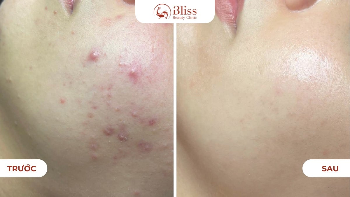 pure skin trị mụn viêm nhẹ