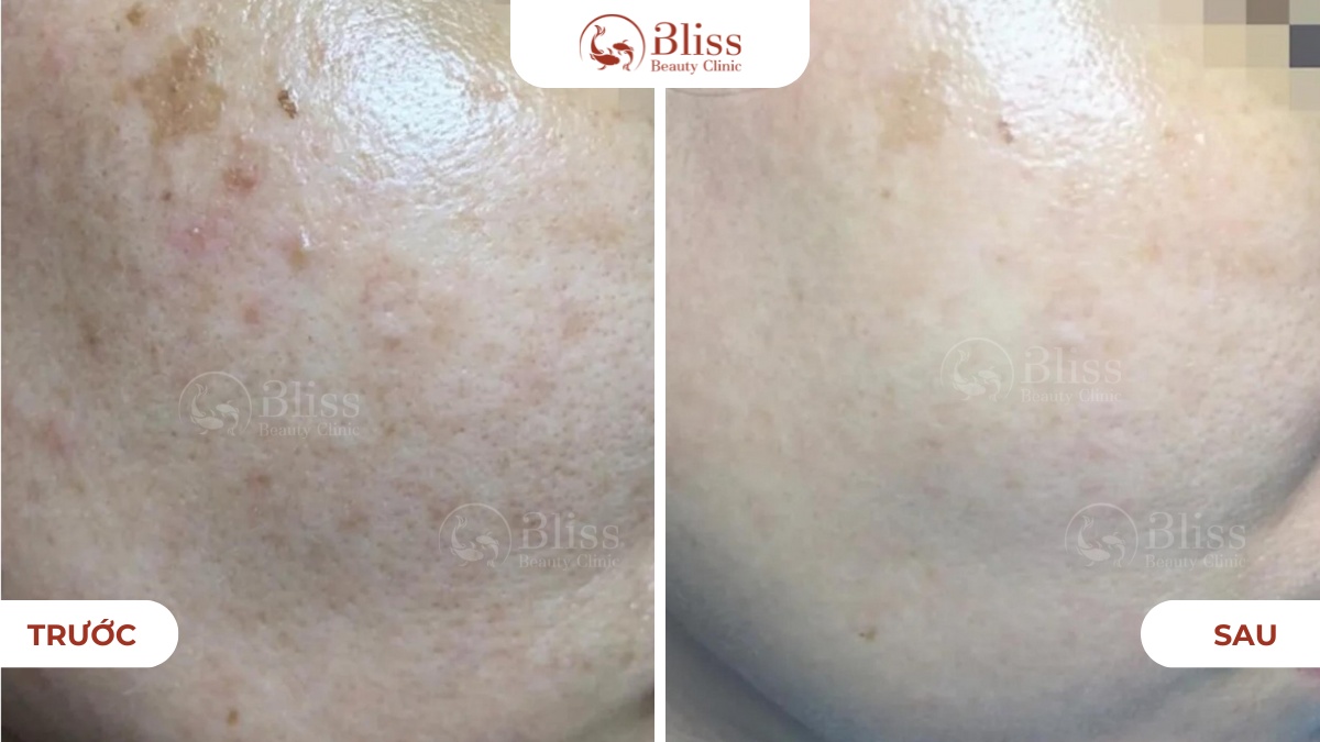 Perfect skin mờ thâm nám