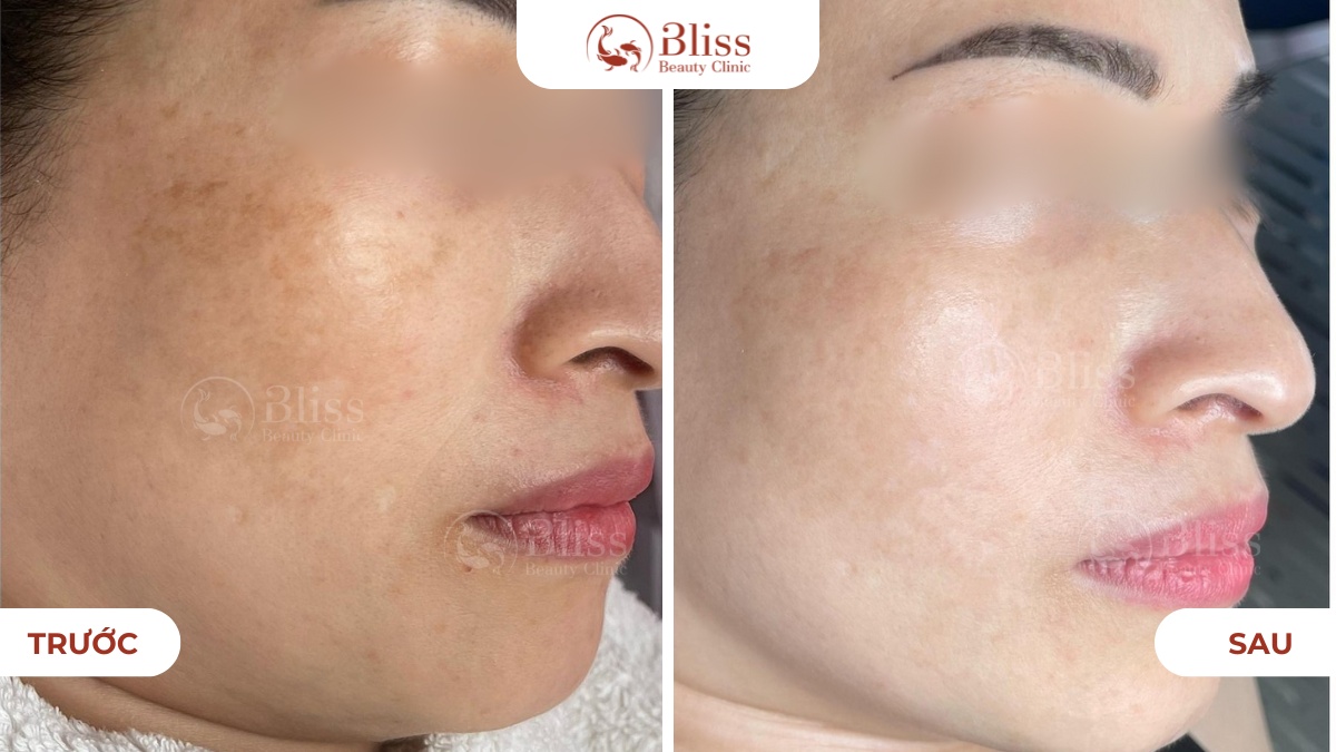 perfect skin mờ thâm nám 