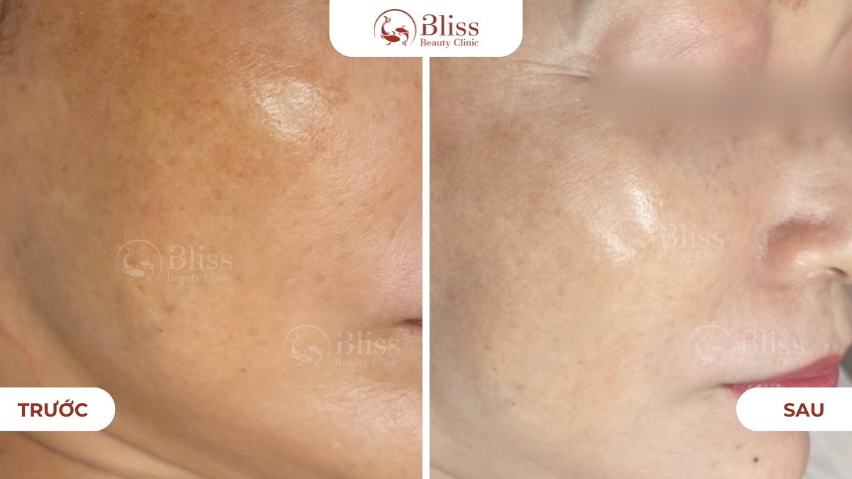 perfect skin mờ thâm nám 