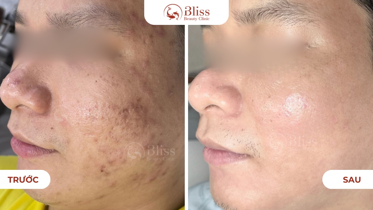 Perfect skin trị mụn toàn diện