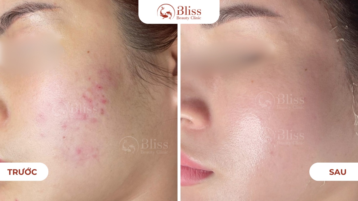 Perfect skin trị mụn toàn diện