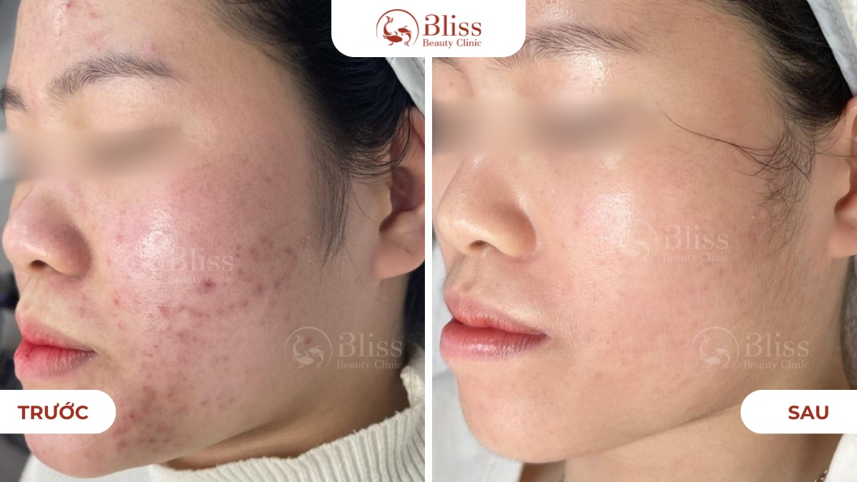 Perfect skin trị mụn toàn diện