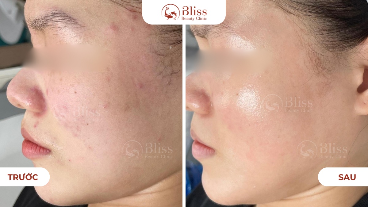 Perfect skin trị mụn toàn diện