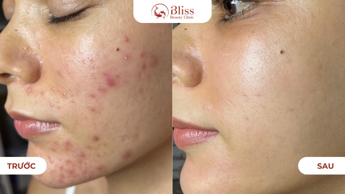 pure skin trị mụn viêm nặng