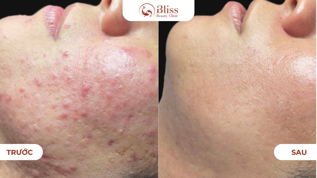 pure skin trị mụn viêm nặng