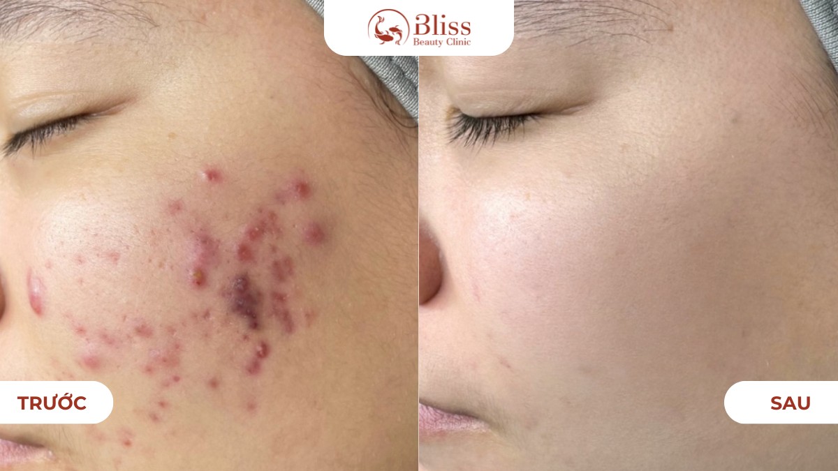 pure skin trị mụn viêm nặng