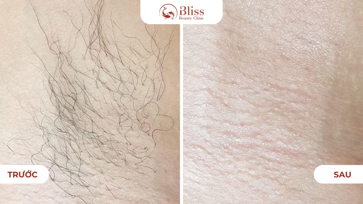 Công nghệ triệt lông DPL