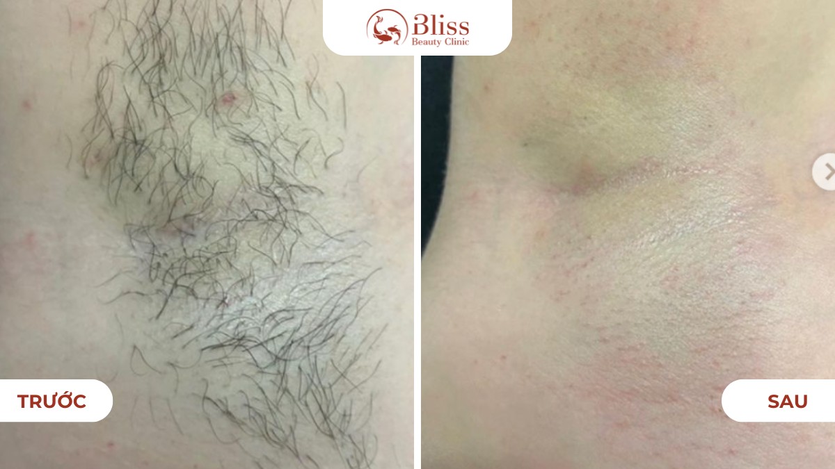 triệt lông nách vĩnh viễn DPL