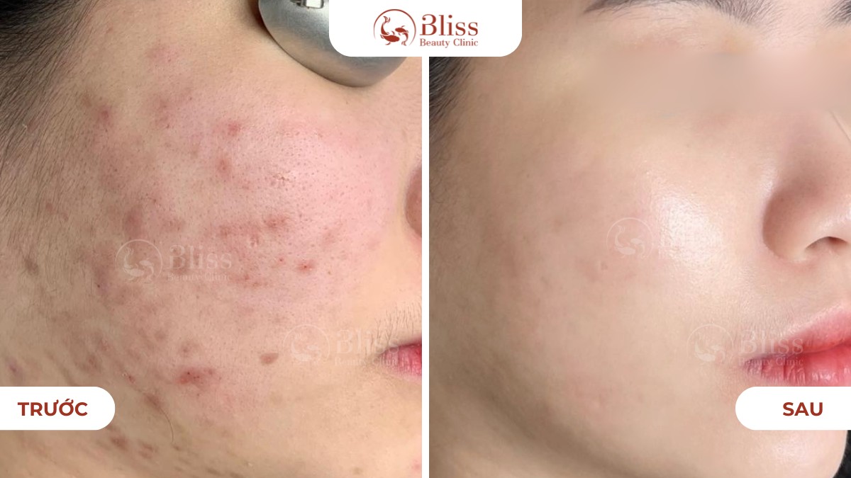 hiệu quả chăm sóc da mụn Hydrogen