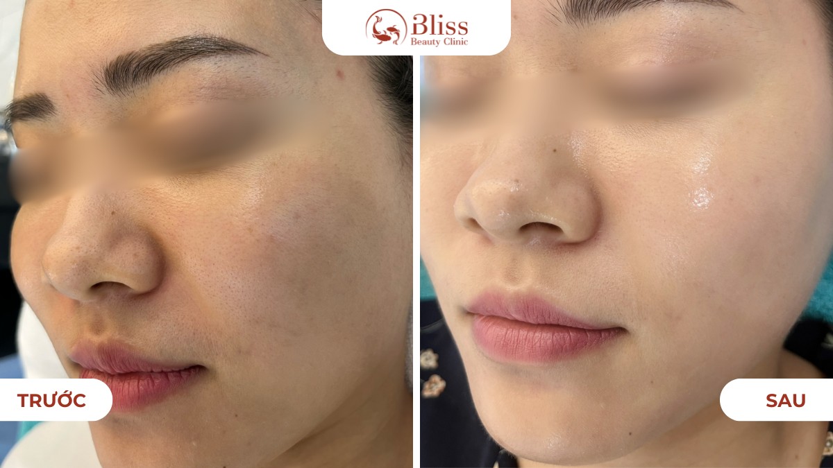 skin booster trẻ hoá da trị nám