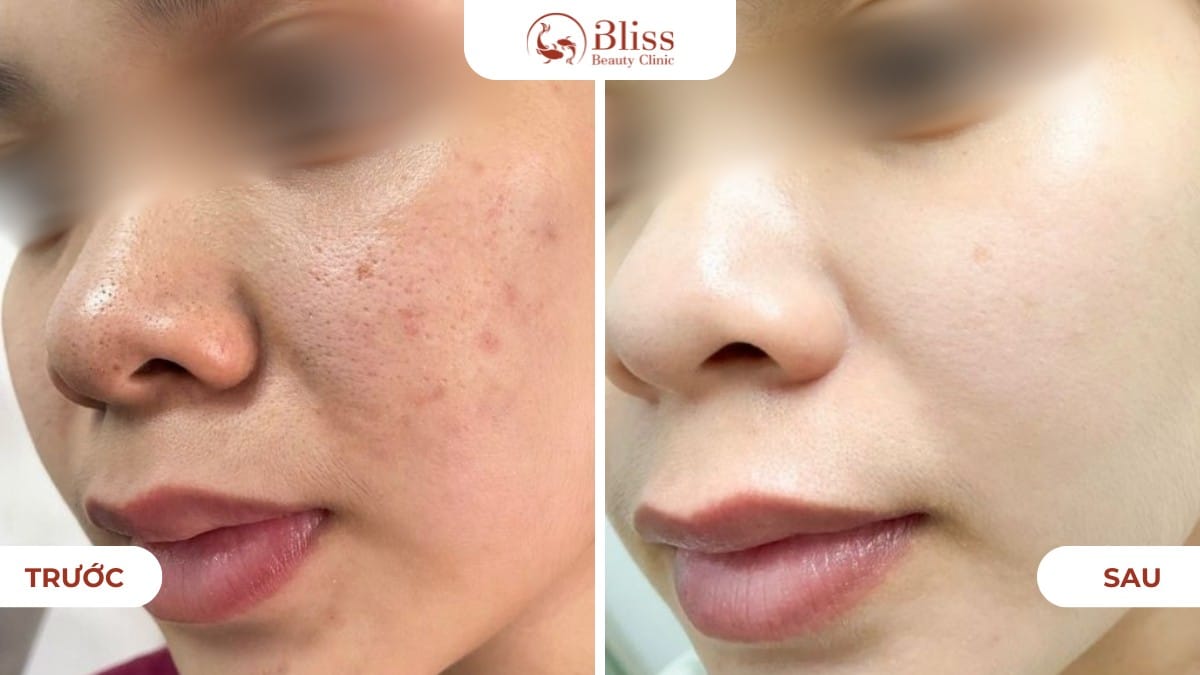 hiệu quả skin booster trẻ hoá da, thu nhỏ lỗ chân lông