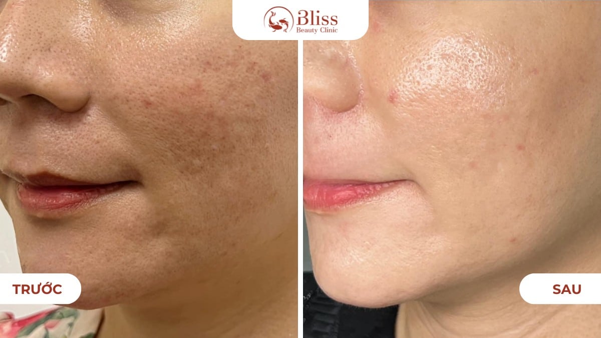 Skin booster trẻ hoá da