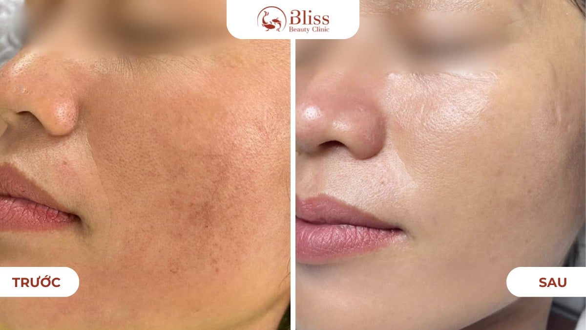 Skin Booster trẻ hoá da mờ nám