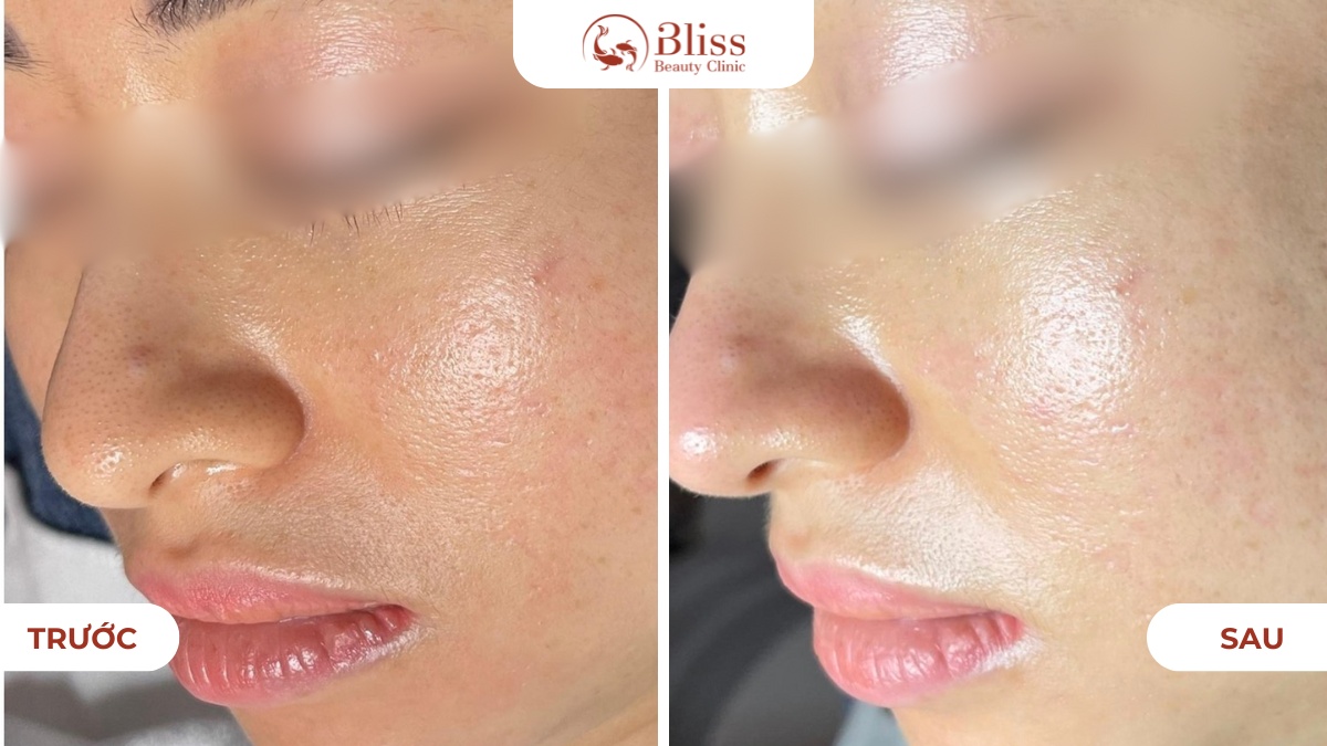 hydrogen sáng da mờ thâm nám