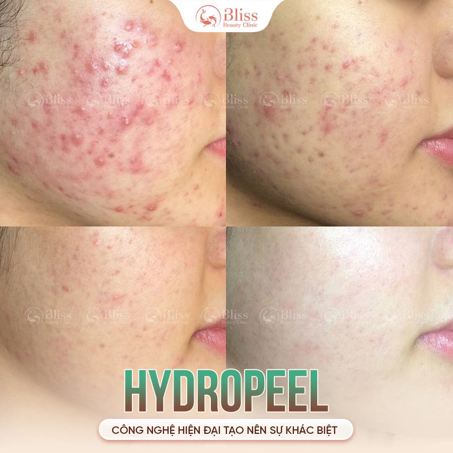 Trị mụn HYDROPEEL