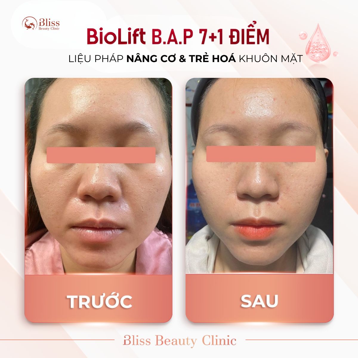 BioLift BAP 7+1 điểm