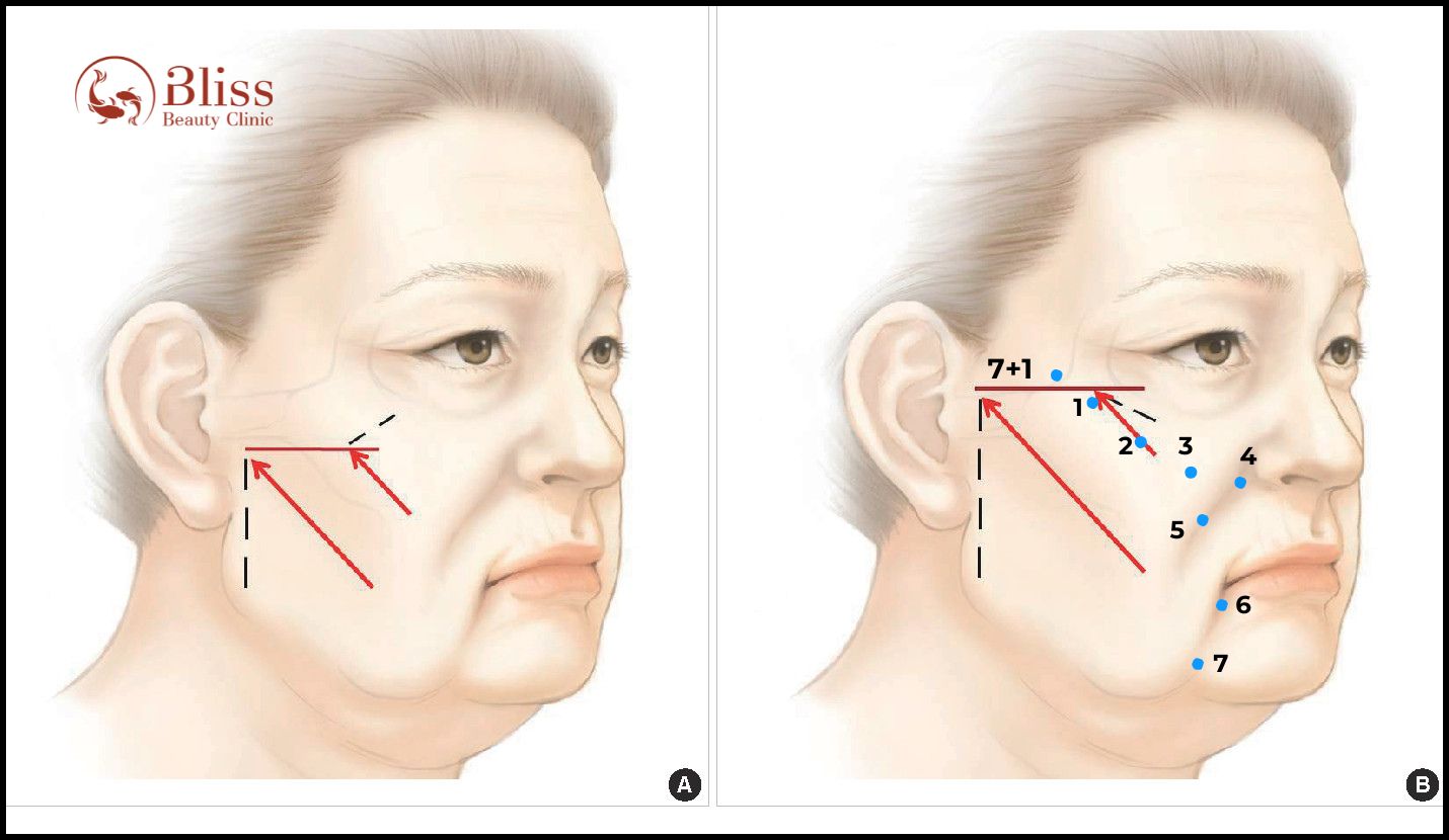 BioLift BAP 7+1 điểm