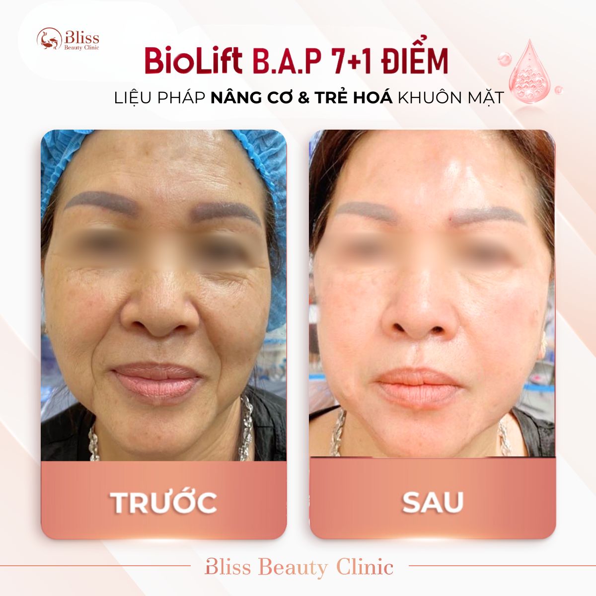 BioLift BAP 7+1 điểm