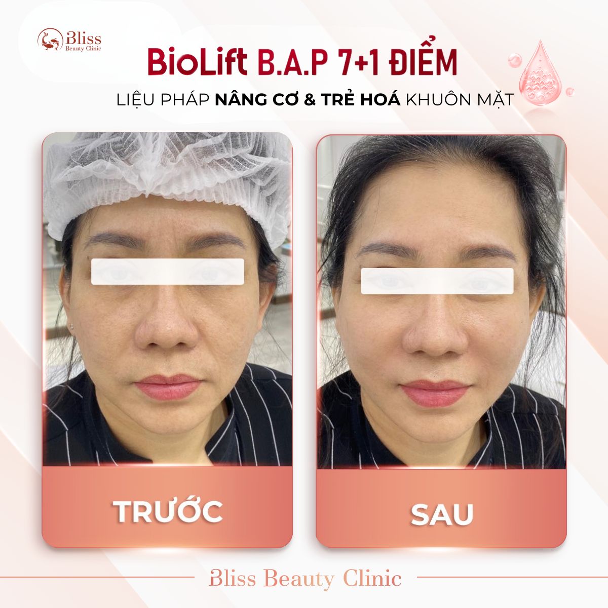 BioLift BAP 7+1 điểm