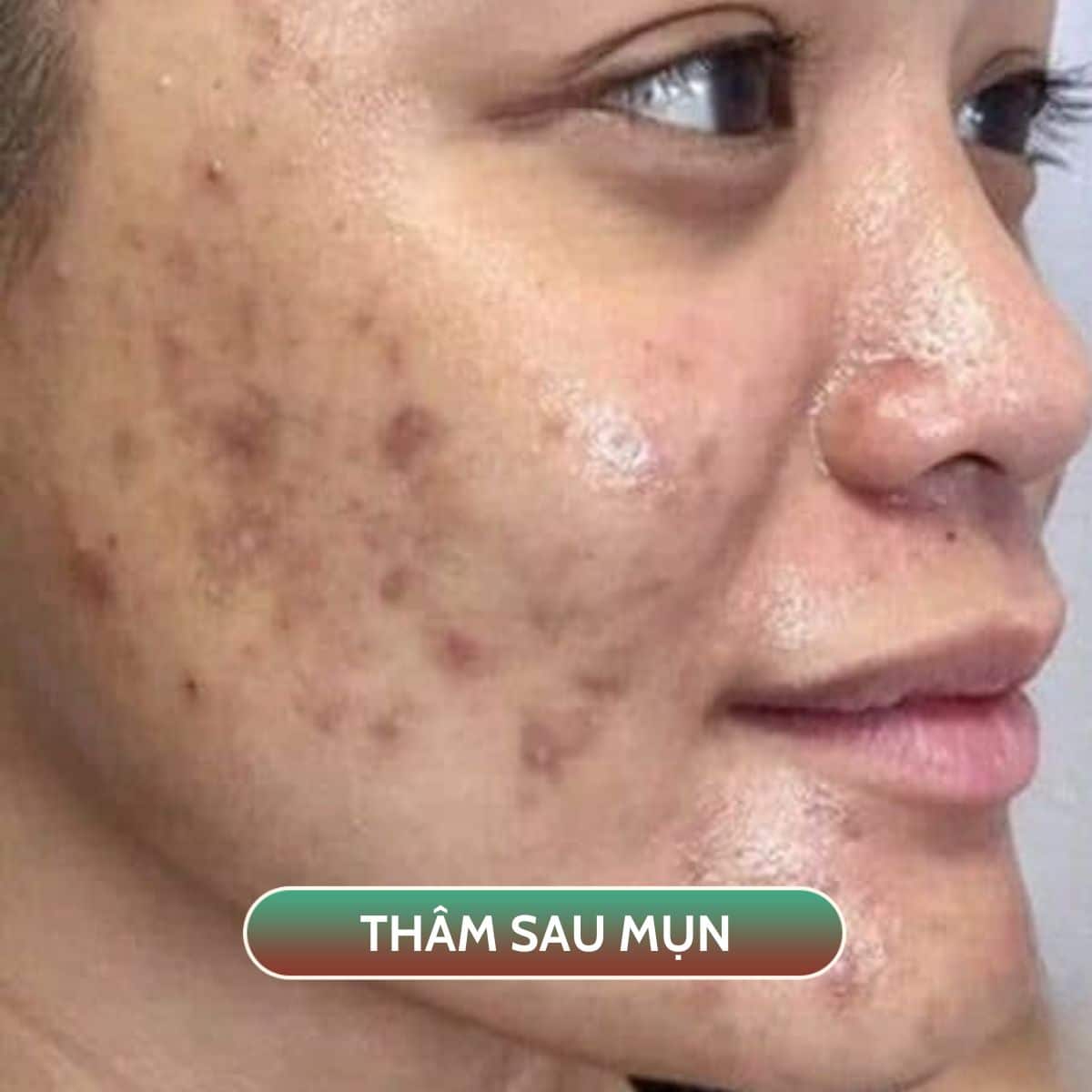 trị thâm mụn Hydropeel