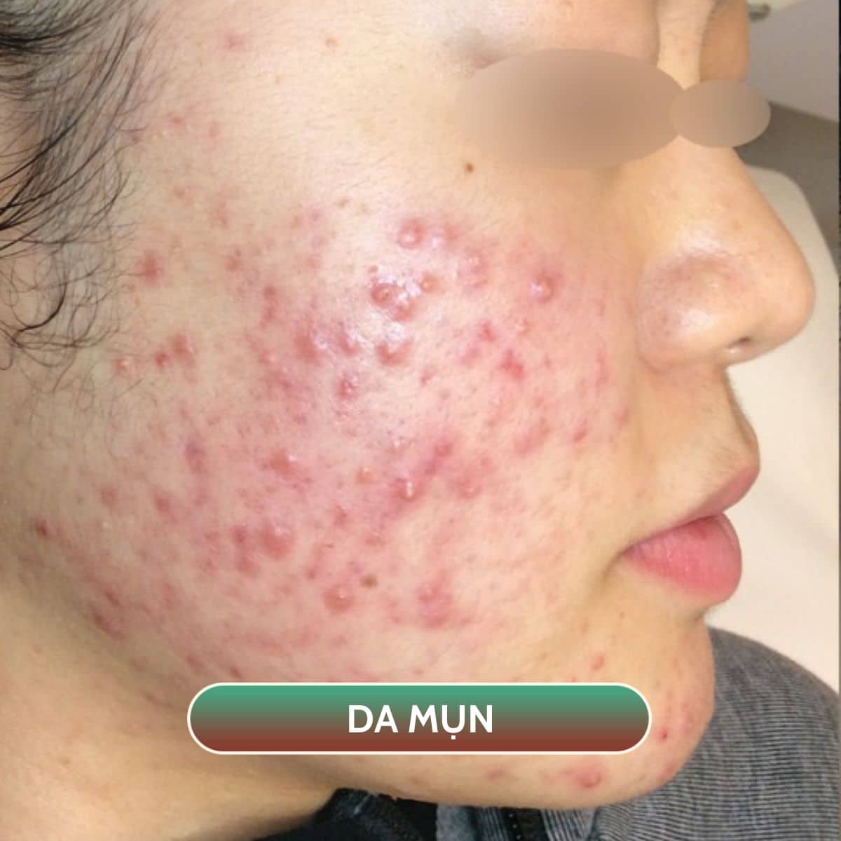 trị mụn công nghệ Hydropeel