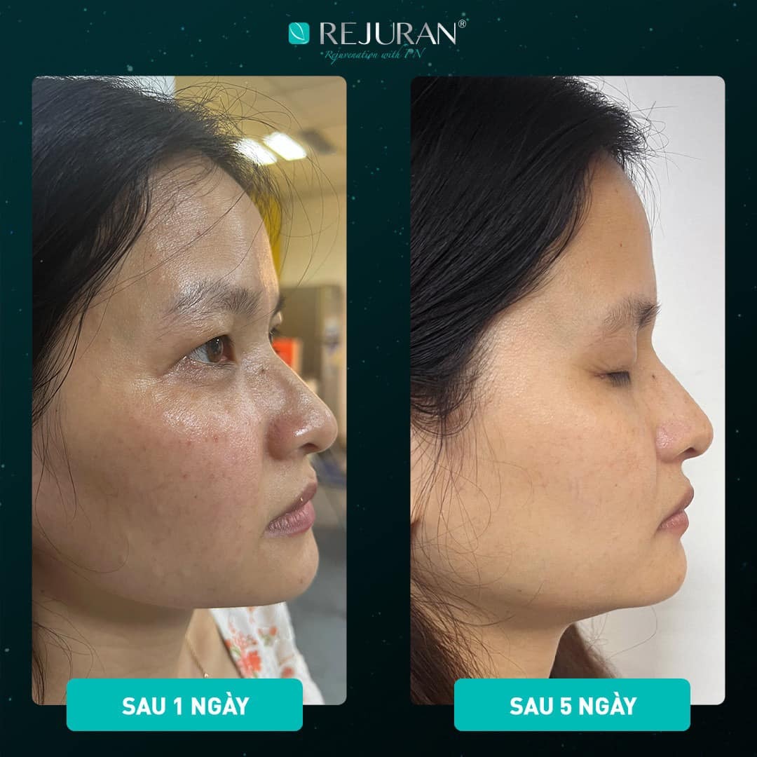 hiệu quả Rejuran căng bóng trẻ hoá da