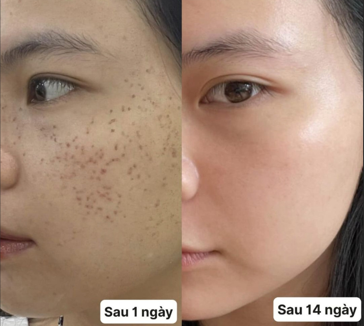tiêm rejuran có an toàn không