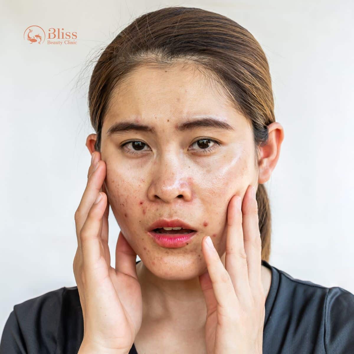 trị mụn khó khăn