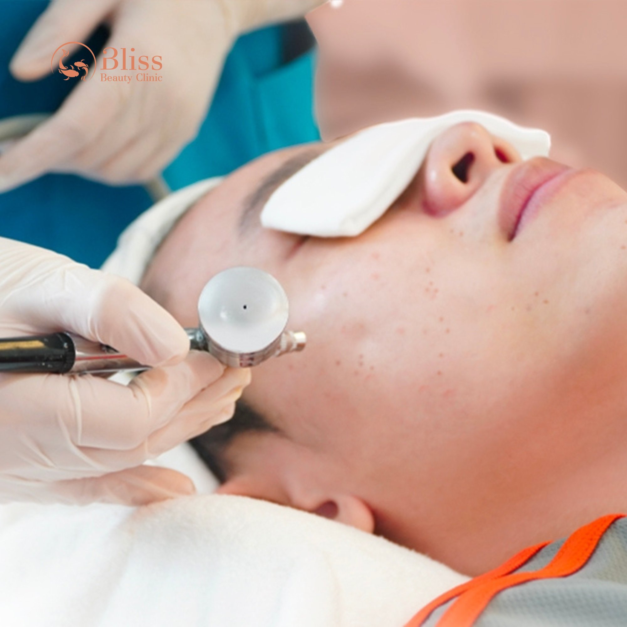 So sánh trị mụn Hydrogen với các phương pháp khác