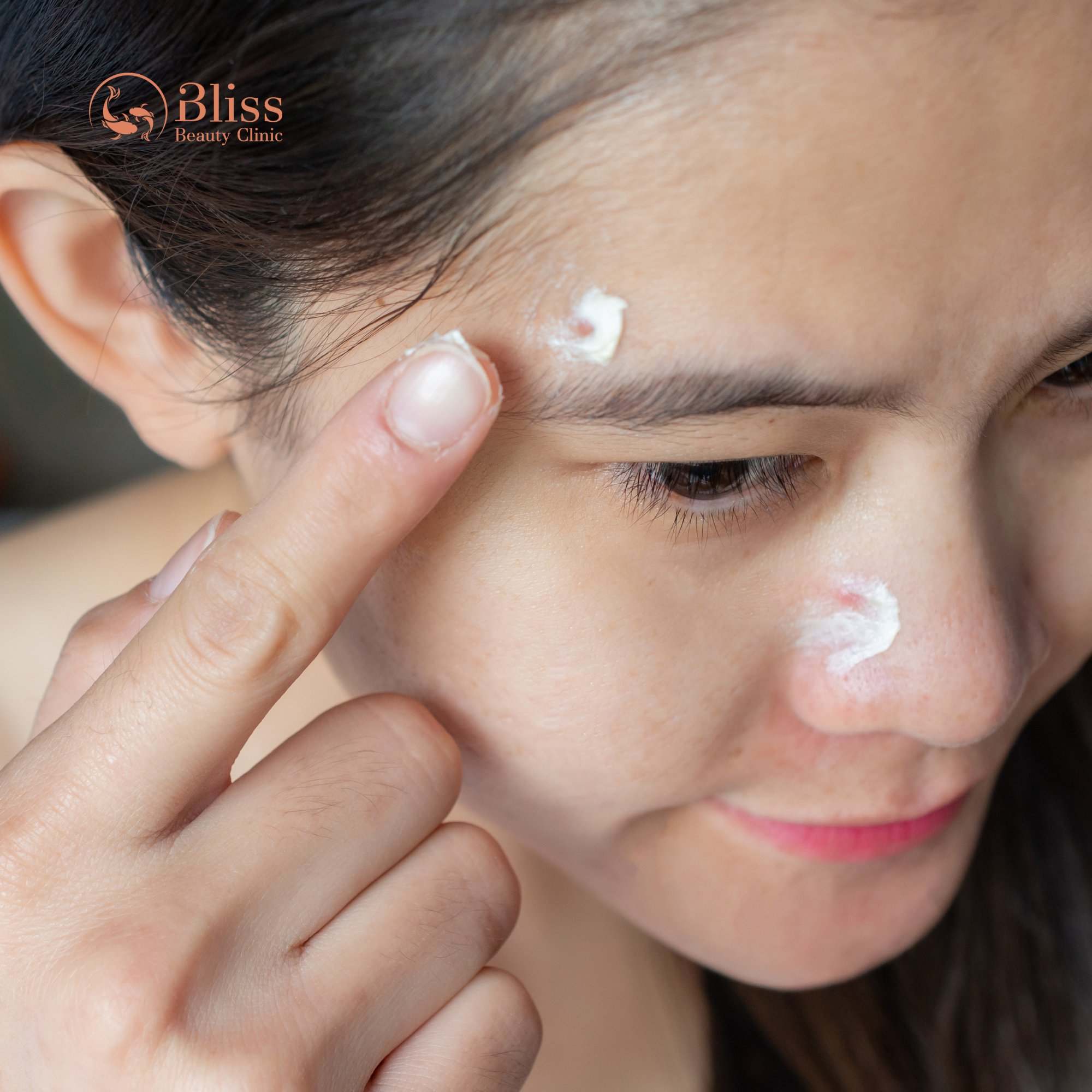 So sánh trị mụn Hydrogen với các phương pháp khác