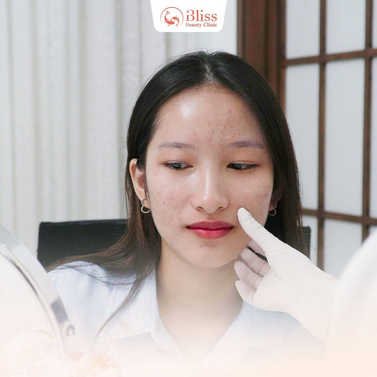 trị mụn hydrogen có hiệu quả không