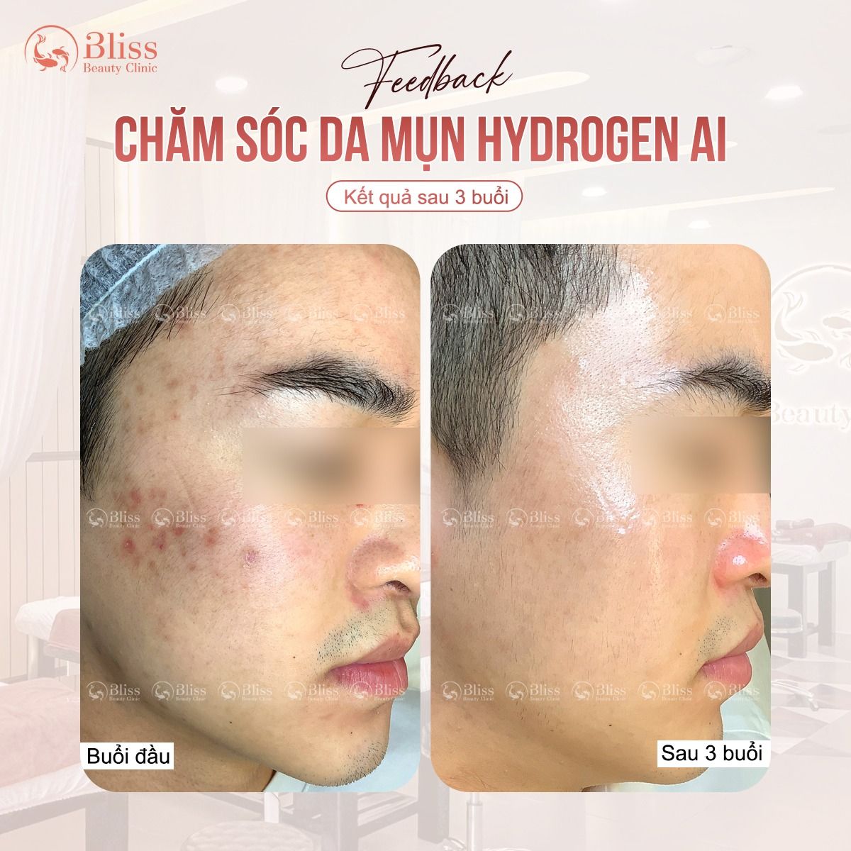 trị mụn hydrogen có hiệu quả không