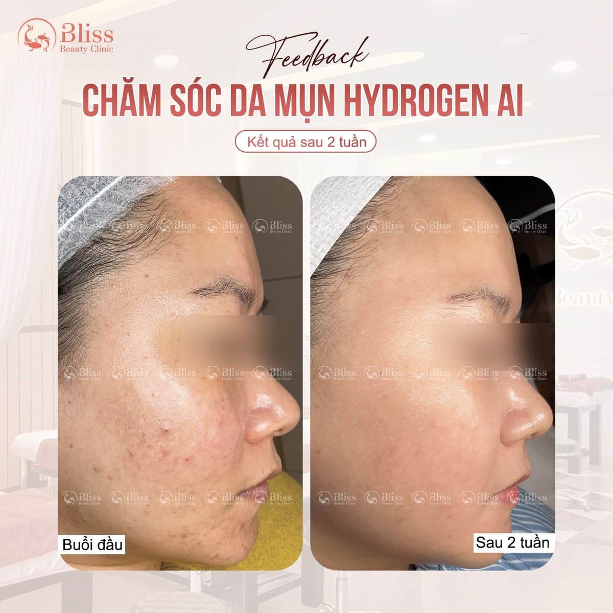 trị mụn hydrogen có hiệu quả không