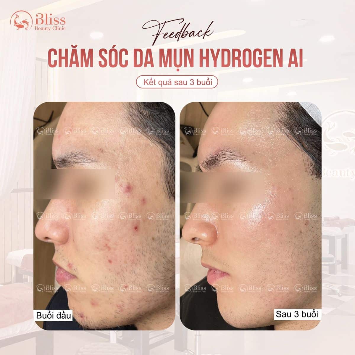 hiệu quả trị mụn hydrogen