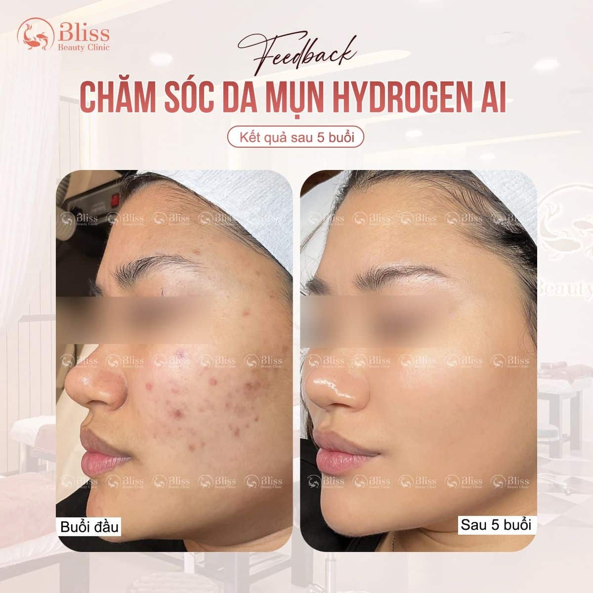 hiệu quả trị mụn hydrogen