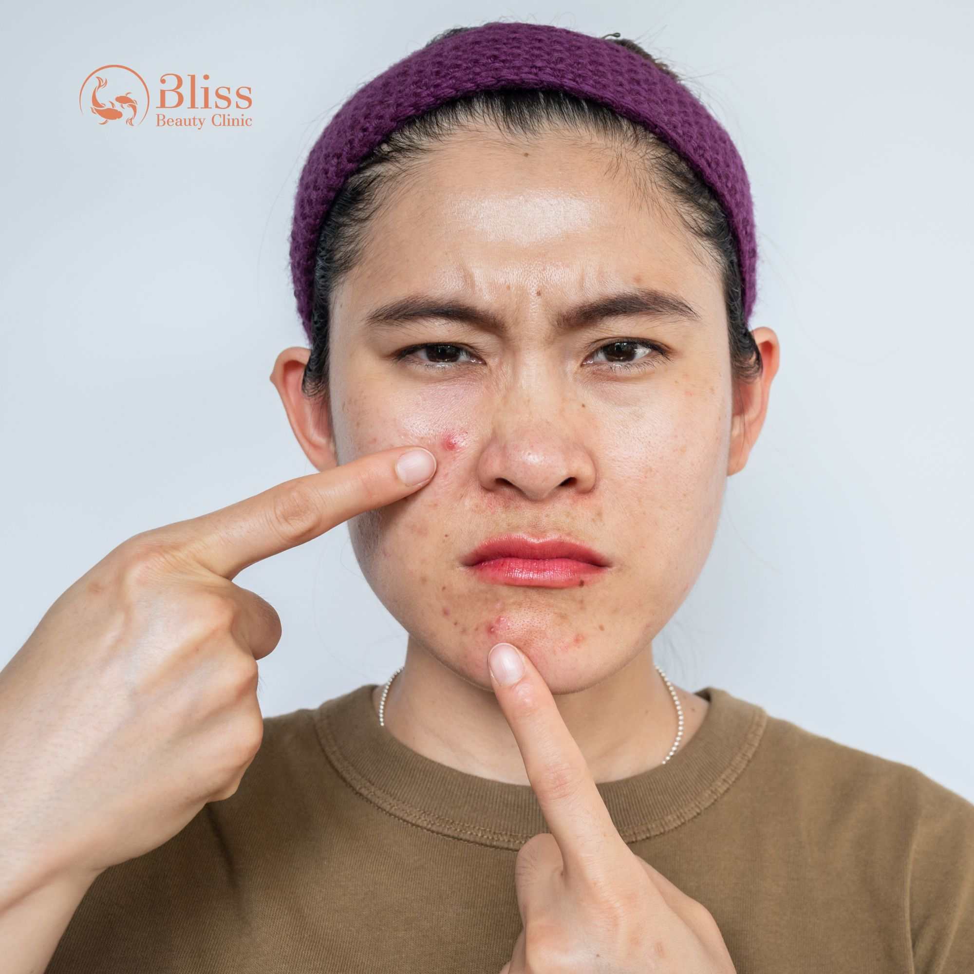 trị mụn Hydrogen có tái phát không