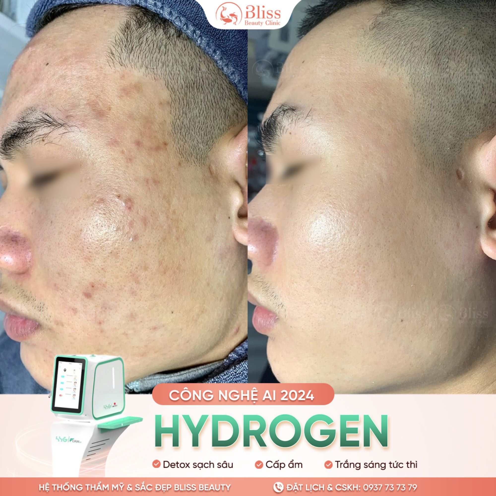 trị mụn Hydrogen có tái phát không