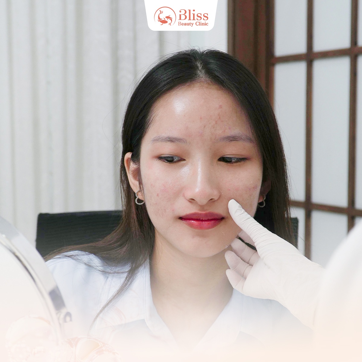 trị mụn Hydrogen giá bao nhiêu