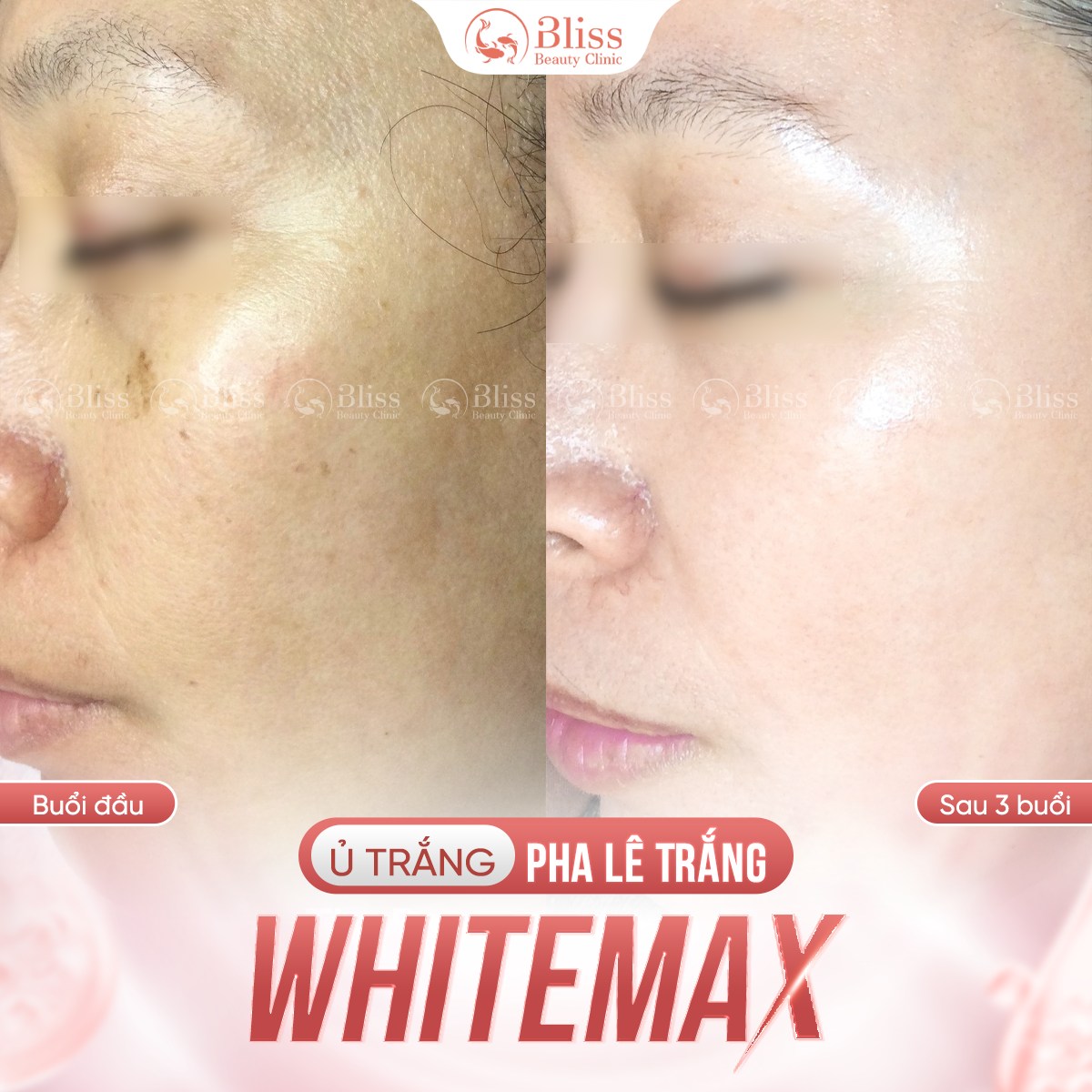 ủ trắng WhiteMax