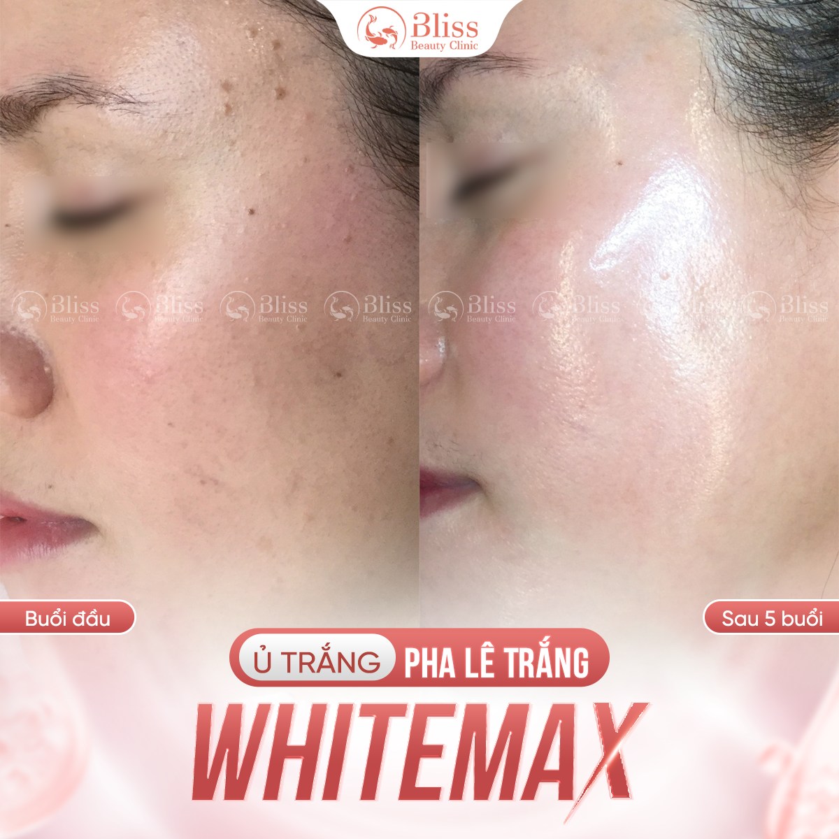 ủ trắng WhiteMax