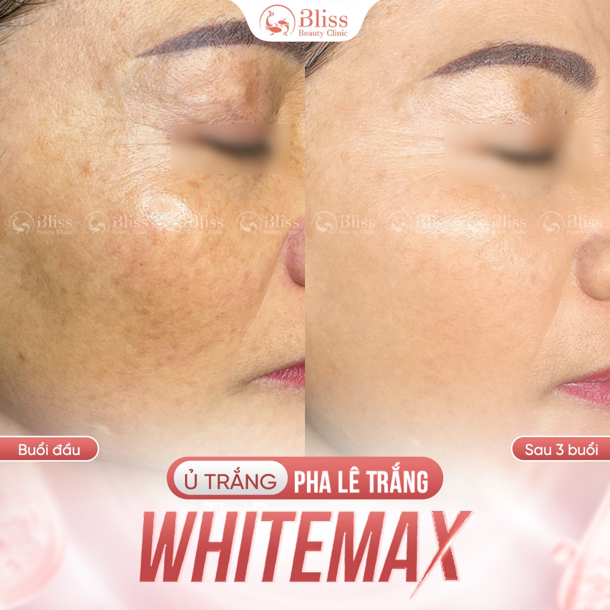 ủ trắng WhiteMax