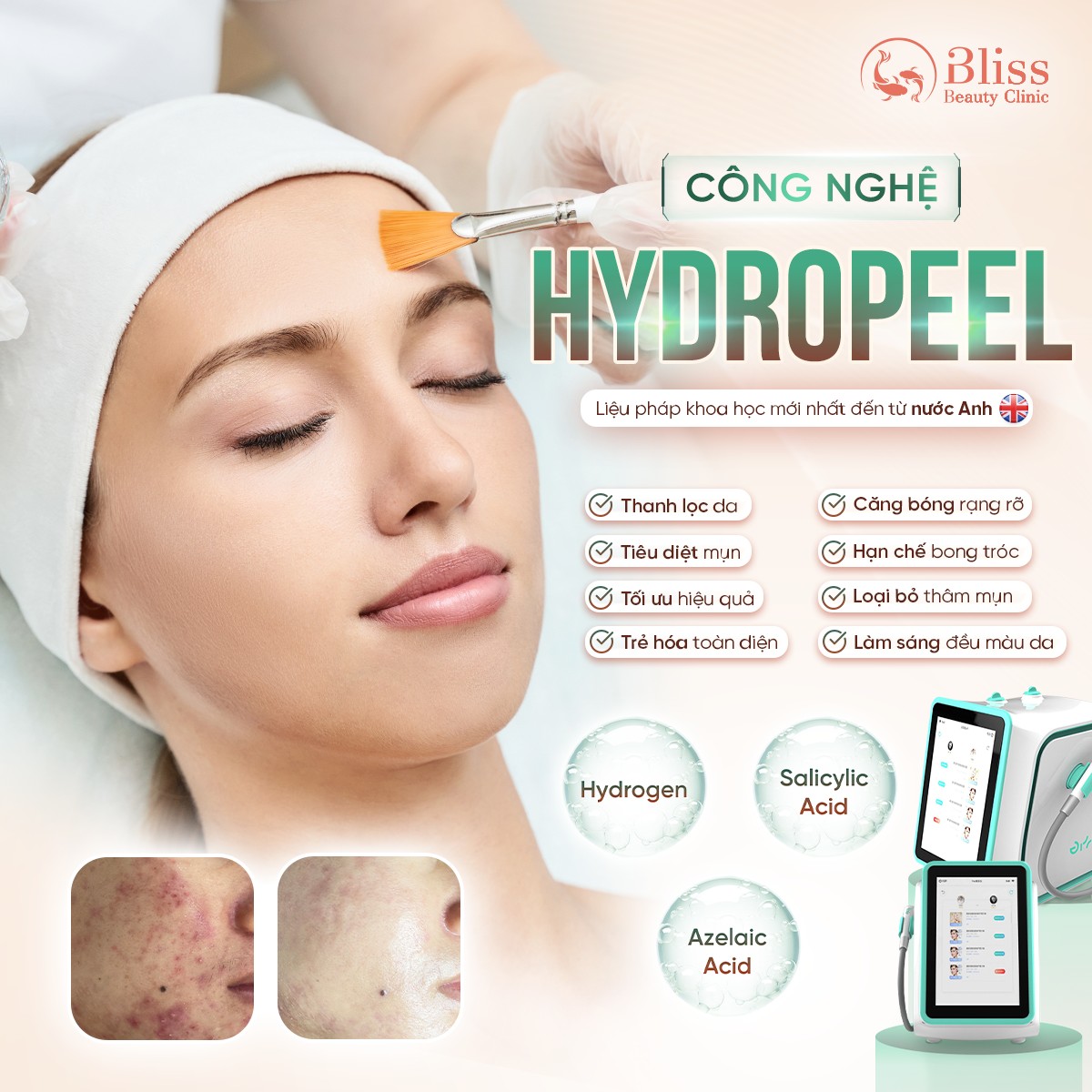 Kiểm soát mụn HydroPeel