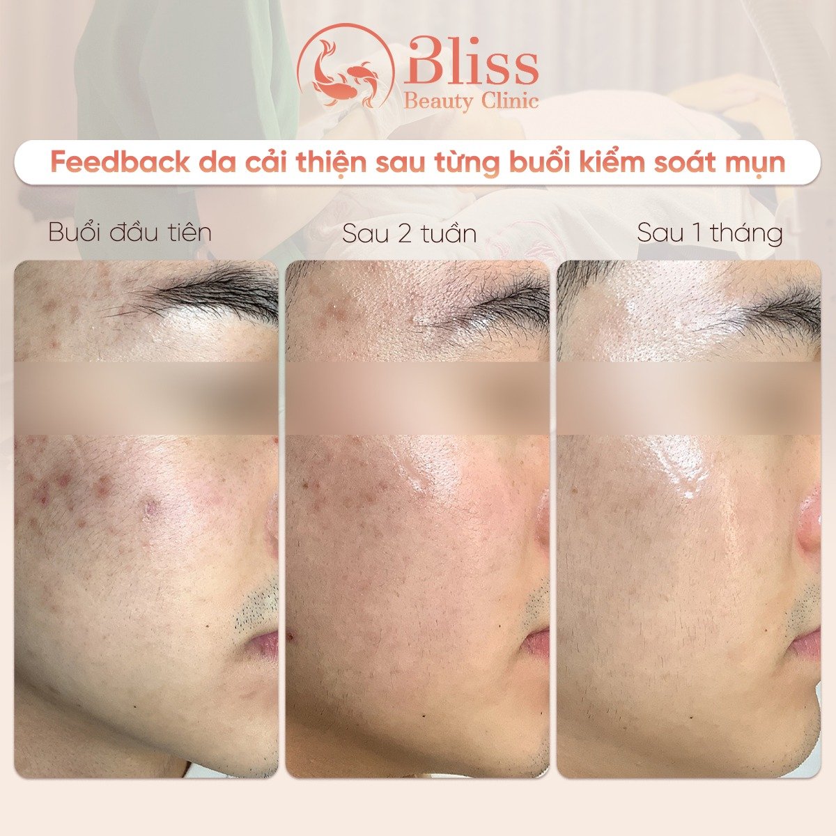 hiệu quả trị mụn Hydrogen