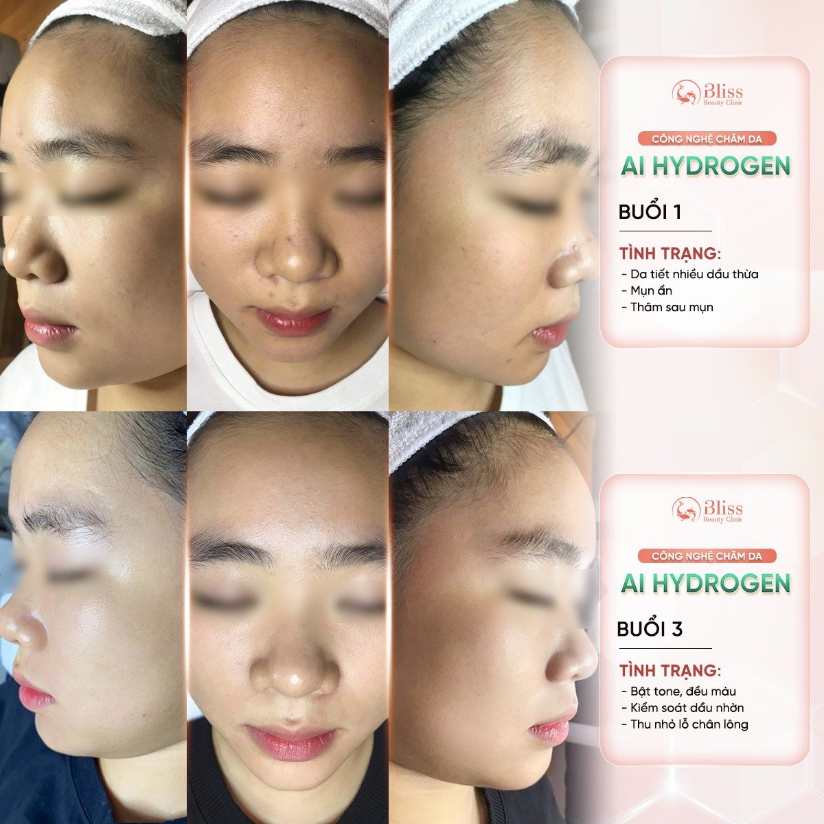 Ứng dụng Hydrigen chống oxy hoá