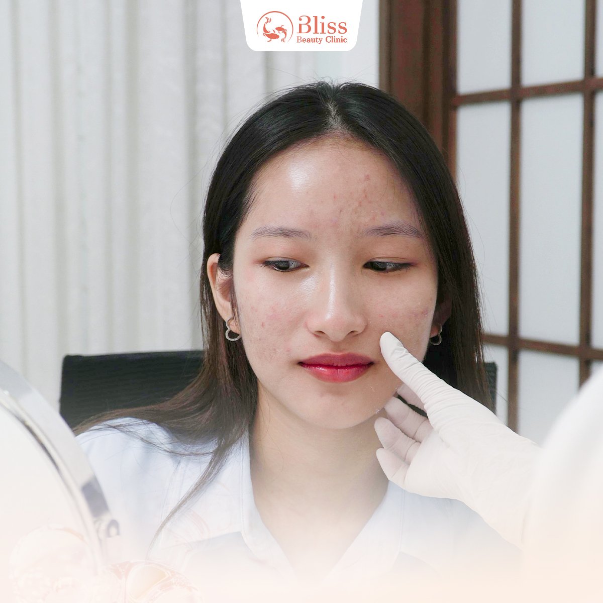 ai nên sử dụng trị mụn hydrogen